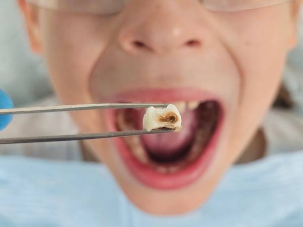 Best Emergency Tooth Extraction  in Floresville, TX